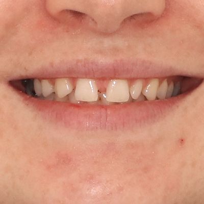 Porcelain Veneers - Smile 1 before